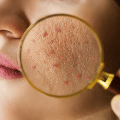 DAMAGED SKIN BARRIER? HOW TO REPAIR AND TAKE CARE OF IT.