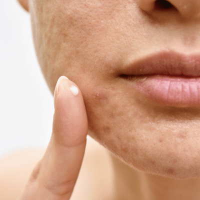 BEST WAYS TO GET RID OF BLACKHEADS AND WHITE HEADS