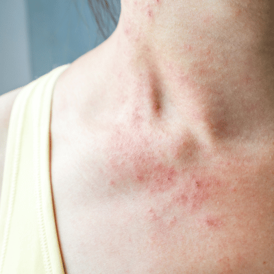 UNDERSTANDING THE DIFFERENT TYPES OF ECZEMA AND WAYS TO TREAT IT