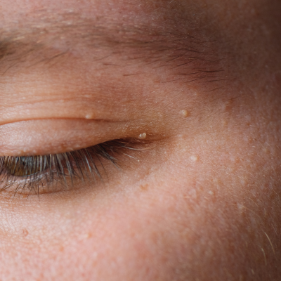 HOW TO GET RID OF HARD WHITE SPOTS ON THE FACE