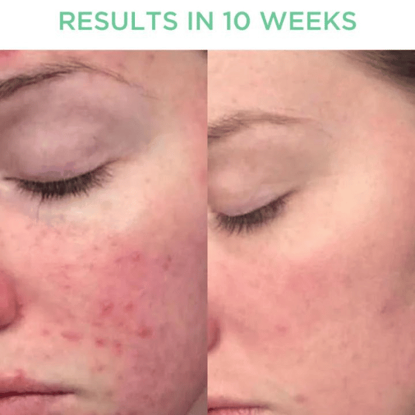 Tribe Skincare Trial Kit - Oily/Combination/Breakouts